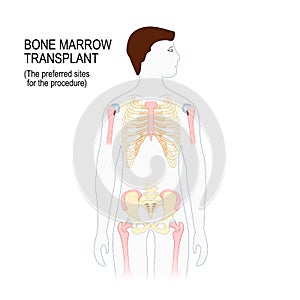 bone marrow transplant. The preferred sites for the transplantation procedure photo
