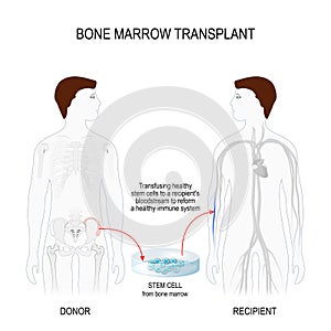 Bone marrow transplantation