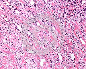 Bone. Osteogenic sarcoma