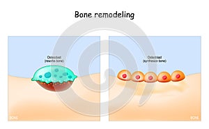 Bone remodeling. Osteoclast resorbs bone, and Osteoblasts synthesized bone tissue.