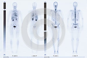 Bone scintigraphy scintigram body 50 years