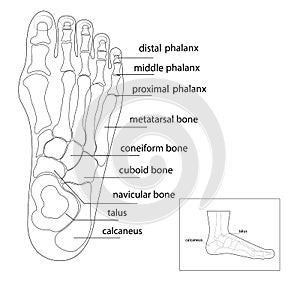 The bone and skin on the sides of the big toe joint form an abnormal foot shape.