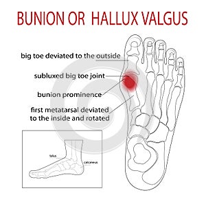 The bone and skin on the sides of the big toe joint form an abnormal foot shape.