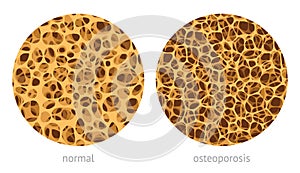 Bone spongy structure