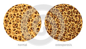 Bone spongy structure photo