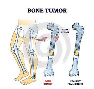 Bone tumor as abdominal tissue growth on human skeleton outline diagram