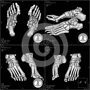 CT foot image