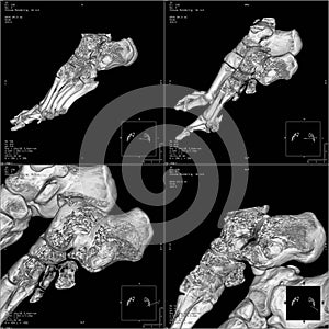 CT foot image photo