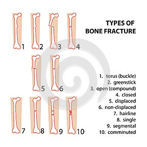 Bones fractures