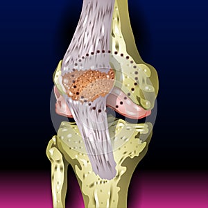 Bones Pain, Injury and Inflammation, Knee Joint Pain Silhouette Icon Ache of Knee, Leg Skeleton, Arthritis, Osteoporosis