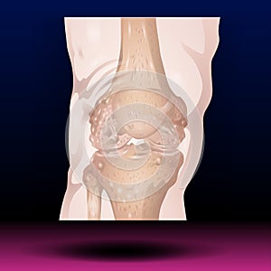 Bones Pain, Injury and Inflammation, Knee Joint Pain Silhouette Icon Ache of Knee, Leg Skeleton, Arthritis, Osteoporosis