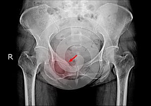 Hip x-ray Fracture right superior pubic ramus.Normal both hips