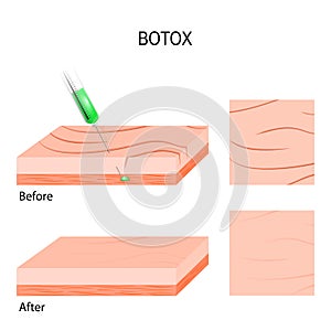 Botox. cosmetic filler