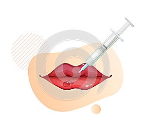 Botulinum Toxin Injection on Lips - Stock Illustration