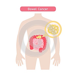Bowel Cancer flat  illustration.