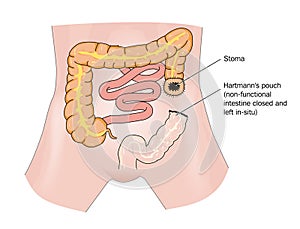Bowel cancer and stoma photo