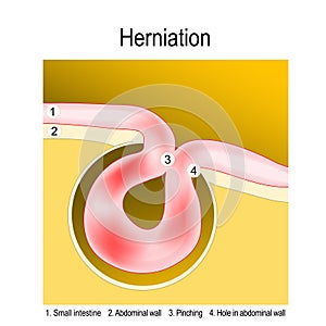 Bowel Obstruction. Hernia