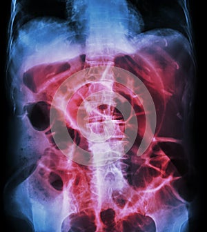 Bowel Obstruction ( X-ray abdomen supine position : large bowel