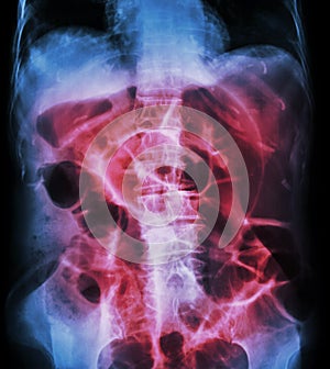 Bowel Obstruction ( X-ray abdomen supine position : large bowel photo