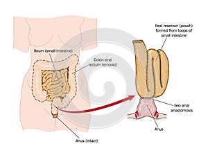 Bowel removed and rectal pouch