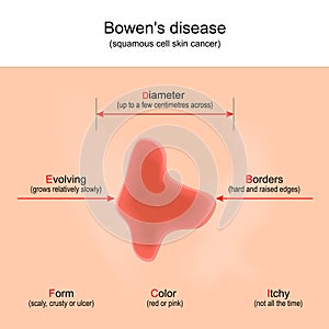 Bowen`s disease. squamous cell skin cancer. photo