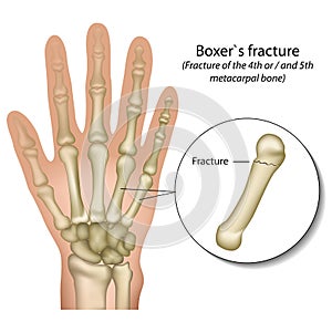 Boxer`s bone hand fracture medical vector illustration