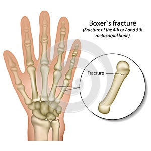 Boxer`s bone hand fracture medical vector illustration photo