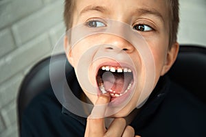 A boy of 6-7 years old shows the first teeth that grow after the loss of milk teeth