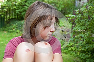 Boy with bruised knee caps.