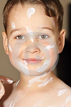 Boy with chicken pox photo