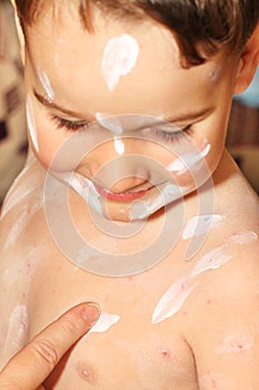 Boy with chicken pox photo