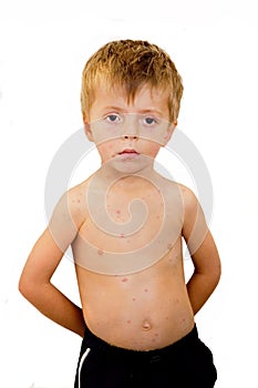 Boy with chicken pox photo