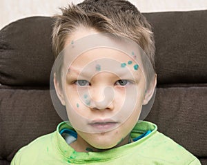 Boy with chicken pox photo