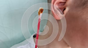 Boy child teenager cleans ear with cotton swab and earwax and dirt
