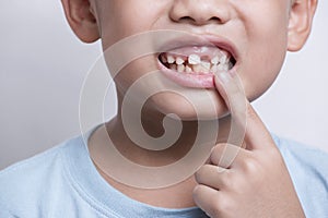 boy face looking at tooth and showing teeth behind on white background. First teeth changing