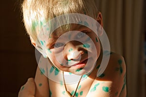 Boy with green dots of chickenpox