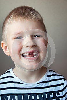 Boy missing milk teeth