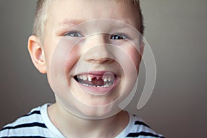 Boy missing milk teeth