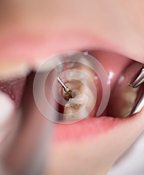 Boy with open mouth during drilling treatment at the dentist in dental clinic