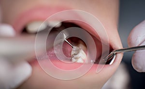 Boy with open mouth during drilling treatment at the dentist in dental clinic