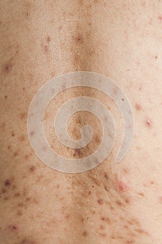 Boy with problematic skin and acne scars