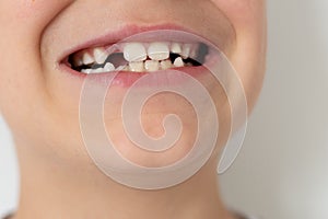 boy showing his lost milk tooth, close up