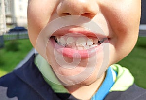 Boy showing white healthy teeth.