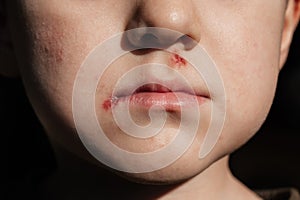 A boy with sores on his face. An ulcer covered with a crust under the nose and at the lip. Dermatological skin disease