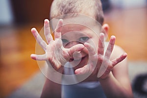 Boy with symptoms hand, foot and mouth disease