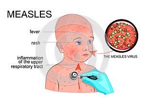 The boy with the symptoms of rubella or measles photo