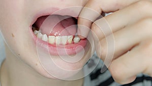 Boy touches, shakes with fingers a crooked milk tooth, close-up macro shot of children's mouth.