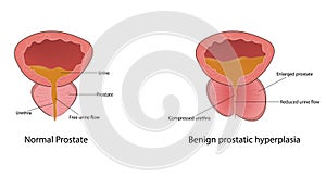 Benign Prostatic Hyperplasia (Enlarged prostate) vector illustration