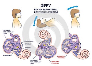BPPV or benign paroxysmal positional vertigo syndrome outline diagram