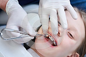 Braces for child teeth correction. Installation and maintenace